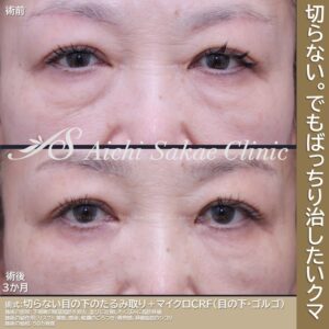 60代 くまとり＋脂肪注入m-CRF