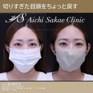 20代　蒙古襞形成