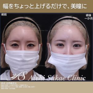 20代　自然癒着法