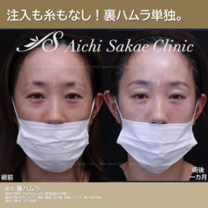 30代　裏ハムラ