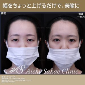 20代　グランドアイ