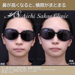 20代　鼻尖形成＋軟骨移植＋鼻翼縮小内側切開