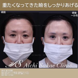 40代　眉下切開