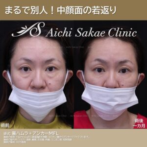 40代　中顔面セット（裏ハムラ＋アンカーリフト）
