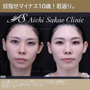 30代　クマ治療パーフェクトセット（裏ハムラ＋MFL＋ｍCRF）