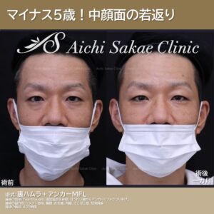 40代　メンズ　裏ハムラ＋アンカーリフト