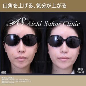 30代　口角挙上