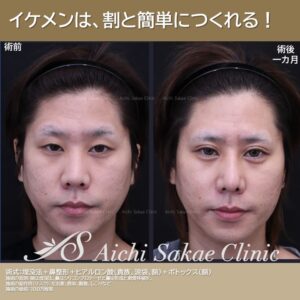 20代　メンズ整形あちこち