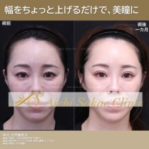 30代　自然癒着法
