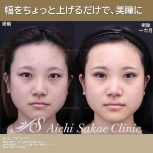 20代　グランドアイ