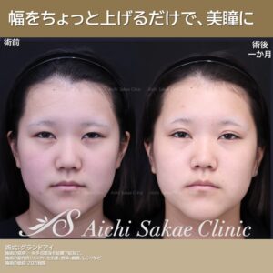 10代　グランドアイ