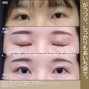 20代　たるみ取り併用全切開眼瞼下垂＋目頭切開　【他院修正】