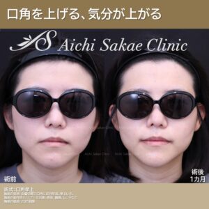 30代　口角挙上
