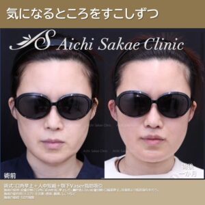 40代 口角挙上+人中短縮+顎下脂肪吸引