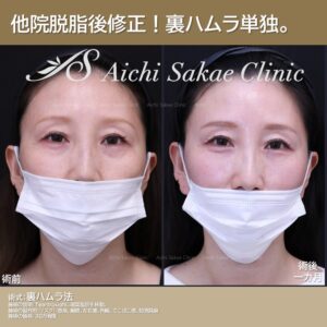 30代　裏ハムラ単独で他院修正
