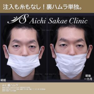 40代　メンズの裏ハムラ