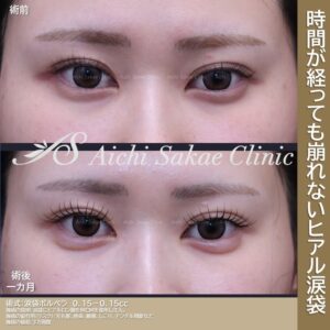 20代　涙袋ヒアルロン酸