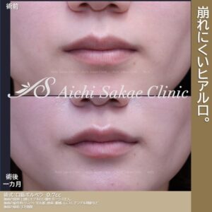 20代　口唇ヒアルロン酸