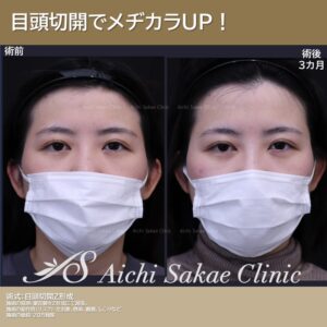 30代　目頭切開単独