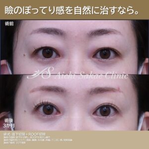 ４０代　眉下切開＋ROOF切除