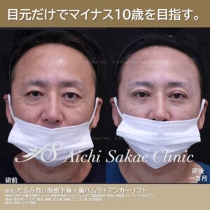 40代男性 全切開眼瞼下垂+裏ハムラ+アンカーリフト