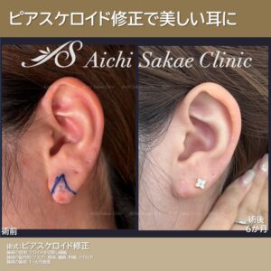 30代 ピアスケロイド