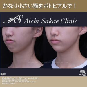 10代女性 顎ボトックス+顎ヒアルロン酸