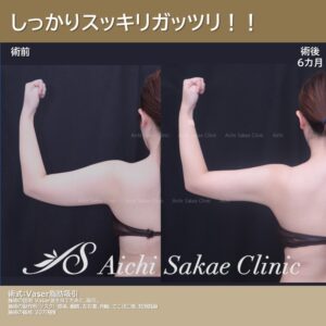 20代　二の腕肩のVASER脂肪吸引