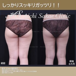 20代　大腿内外側のVASEＲ脂肪吸引