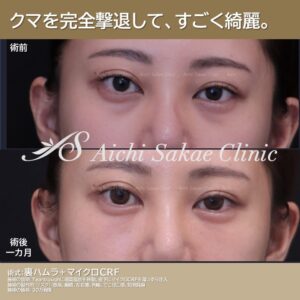 20代女性 裏ハムラ+マイクロCRF