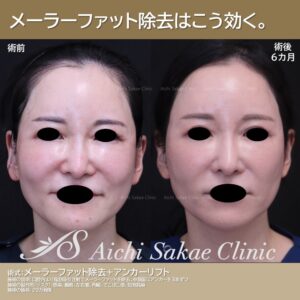40代 メーラーファット除去+アンカーリフト