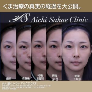 20代 裏ハムラ+マイクロCRF