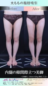20歳代　太ももの脂肪吸引