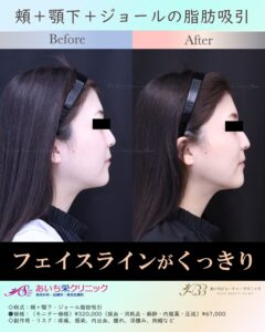 20歳代　お顔の脂肪吸引