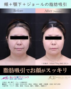 30歳代　お顔の脂肪吸引