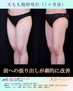 30歳代　●太ももの脂肪吸引