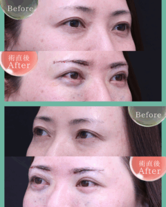 【スタッフ施術】裏ハムラ、眉下切開