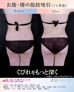 30歳代　お腹・腰のベイザー脂肪吸引