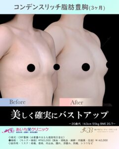 20歳代　CRF豊胸の症例