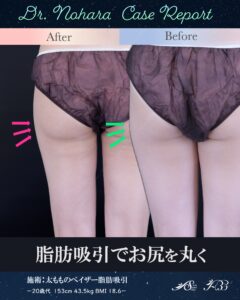 20歳代　太もものベイザー脂肪吸引