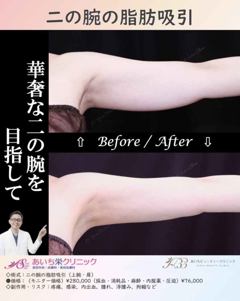 30歳代 ○二の腕の脂肪吸引 | 名古屋・安城の美容外科・美容皮膚科