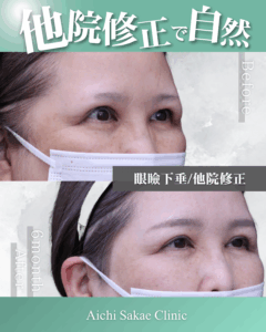 ５０代　眼瞼下垂(他院修正)