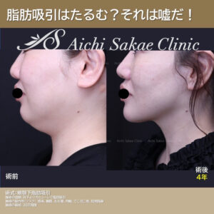４０代　脂肪吸引(頬＋顎)