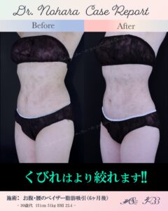 30歳代　お腹・腰のベイザー脂肪吸引から６ヶ月