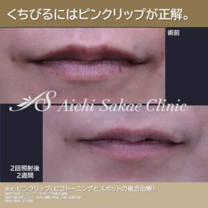 20代　ピンクリップ