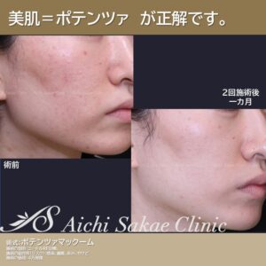 20代　ポテンツァマックーム