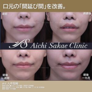 20代　人中短縮