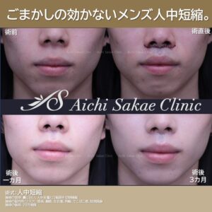 20代男性　人中短縮