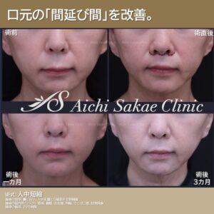 40代　人中短縮