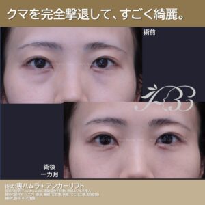 20代　裏ハムラ＋アンカーリフト